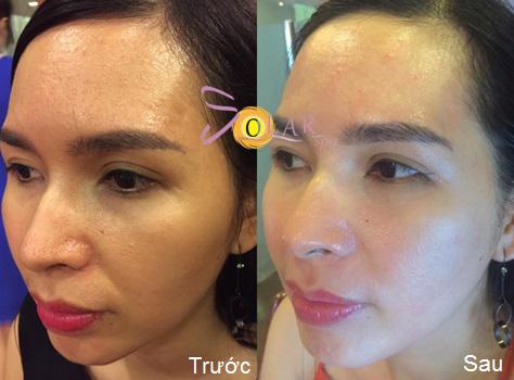 solar-245-4-ngoisao 1 Xóa nhăn, Nâng cơ mặt, Solar spa, Solar spa khuyến mại