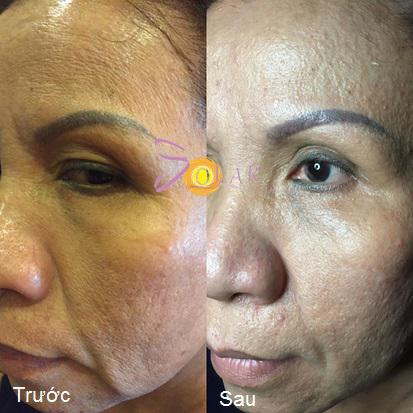 solar-245-5-ngoisao 0 Xóa nhăn, Nâng cơ mặt, Solar spa, Solar spa khuyến mại