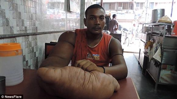 cánh tay khổng lồ nặng 20kg, cánh tay voi, kỳ lạ, đột biến gen