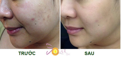 solar-spa-315-2-ngoisao 2 Trẻ hóa da, Solar spa, Công nghệ trẻ hóa da, Trẻ hóa da không phẫu thuật