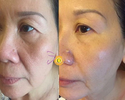 solar-spa-315-3-ngoisao 1 Trẻ hóa da, Solar spa, Công nghệ trẻ hóa da, Trẻ hóa da không phẫu thuật