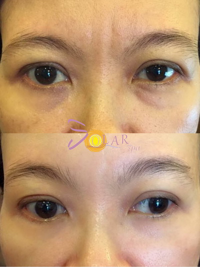 solar-spa-315-4-ngoisao 0 Trẻ hóa da, Solar spa, Công nghệ trẻ hóa da, Trẻ hóa da không phẫu thuật