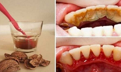 Cao răng, mảng bám cao răng, loại mảng bám cao răng, óc chó, chăm sóc răng, bệnh về răng, tai mũi họng