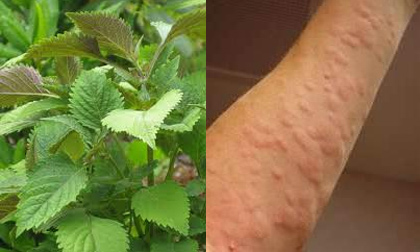  mề đay, dị ứng, bài thuốc chữa mề đay