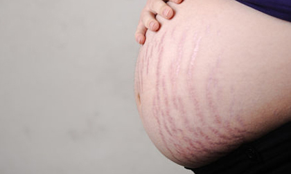 rạn da, cách chữa rạn da, khắc phục rạn da khi mang bầu, chữa rạn da khi mang bầu