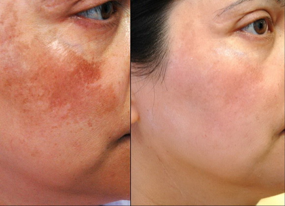 tri-nam-146-2-ngoisao 2 Medi White, Trị nám, Trị tàn nhang