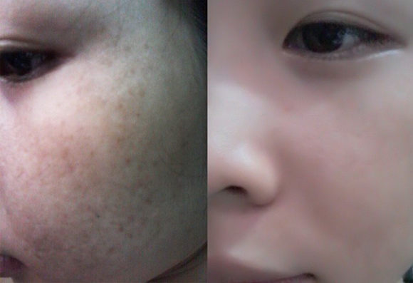 tri-nam-146-3-ngoisao 1 Medi White, Trị nám, Trị tàn nhang