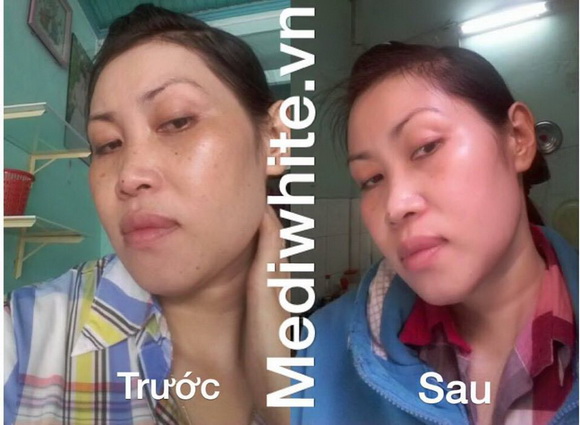 tri-nam-146-4-ngoisao 0 Medi White, Trị nám, Trị tàn nhang