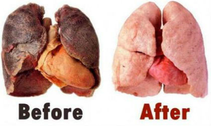 ung thu phoi, ung thư phổi, giảm ung thư phổi, ăn gì để không bị ung thư, thuốc lá