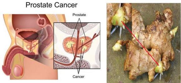 gừng, ung thư, gừng và ung thư, ung thư ruột kết, ung thư buồng trứng, ưng thư tuyến tiền liệt