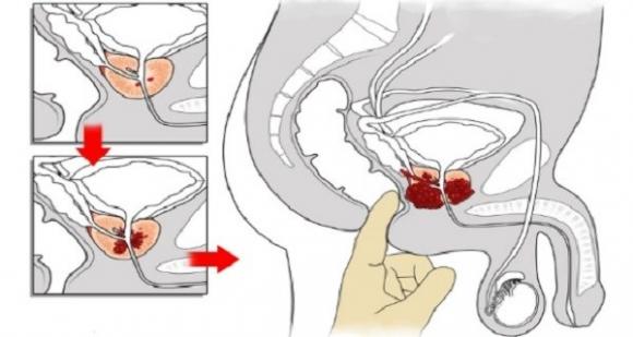 gừng, ung thư, gừng và ung thư, ung thư ruột kết, ung thư buồng trứng, ưng thư tuyến tiền liệt