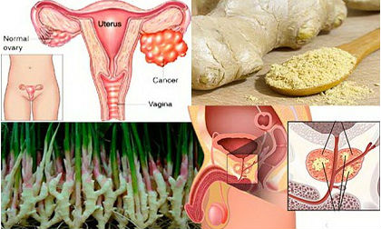 ung thu buong trung, ung thư buồng trứng, bệnh phụ nữ, phụ khoa, sức khỏe