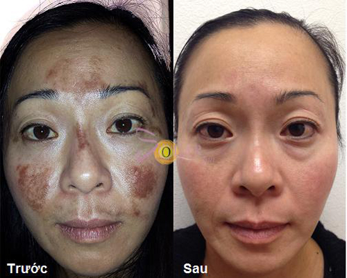 tri-nam-da-67-2-ngoisao 3 Trị nám, Trị tàn nhang, Trị nám hiệu quả, Solar spa