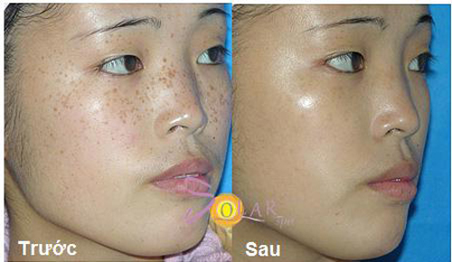 tri-nam-da-67-4-ngoisao 1 Trị nám, Trị tàn nhang, Trị nám hiệu quả, Solar spa