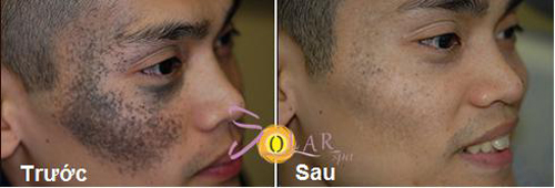 tri-nam-da-67-5-ngoisao 0 Trị nám, Trị tàn nhang, Trị nám hiệu quả, Solar spa