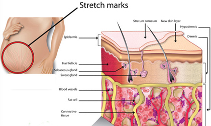 rạn da, rạn da sau sinh, phụ nữ bị rạn da