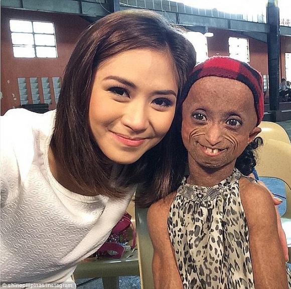 đời sống trẻ,cô gái Philippines có gương mặt như bà lão,Ana Rocelle,cô gái bị bệnh lão hóa