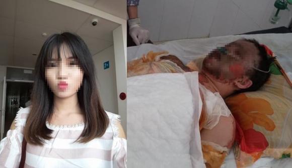 Cô gái bị bỏng toàn thân mặt biến dạng, Cô gái xinh đẹp bị bỏng toàn thân, Bỏng toàn thân sau tai nạn