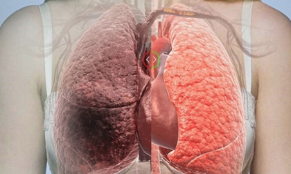 ung thư phổi, ung thư, nguyên nhân ung thư phổi, nguyên nhân hàng đầu gây bệnh ung thư phổi, phổi