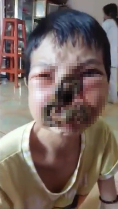 Cô gái mắc bệnh ăn mòn khuôn mặt, Bệnh ăn mòn khuôn mặt, Cô gái xinh đẹp mắc bệnh ăn mòn khuôn mặt