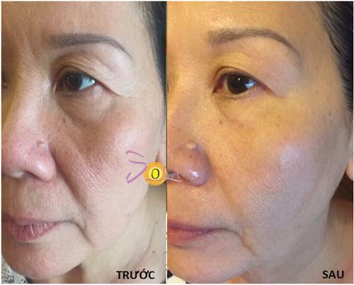 Xóa nhăn, nâng cơ mặt, Solar spa