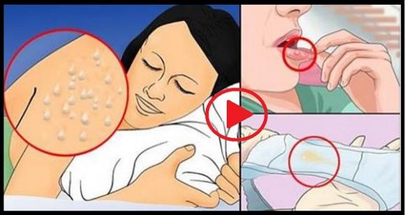 HIV, HIV nhiễm giai đoạn đầu, dấu hiệu HIV, dấu hiệu nhiễm HIV giai đoạn đầu, dấu hiệu nhiễm HIV, dau hieu nhiem HIV