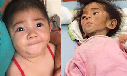 bé gái Lào Cai 14 tháng tuổi nặng 3,5kg, bé gái Lào Cai 14 tháng tuổi nặng 3,5kg hiện nay, Bé Yến Nhi