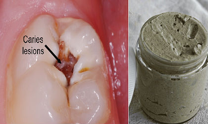 gel tái tạo men răng, tái tạo men răng hiệu quả, chữa sâu răng