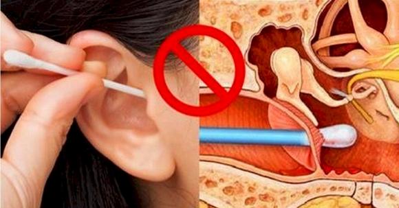 bông ngoáy tai, tác hại của bông ngoáy tai, ráy tai, làm sạch tai, loại bỏ ráy tai