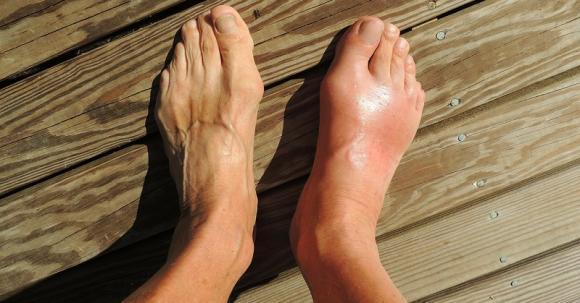 Nước trái cây chữa bệnh gout, chữa gout trong 2 ngày, gout