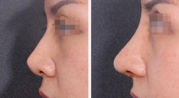 Nâng ngực nội soi, Độn cằm V-line, sửa mũi Sline, Bệnh viện Thẩm mỹ Hiệp Lợi