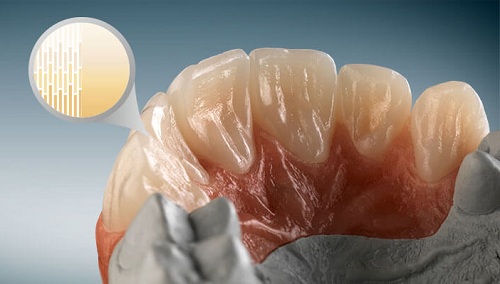 rang-su-211-3-ngoisao.vn-w500-h284 2 Nha khoa đông nam, Bọc răng sứ, Làm răng sứ, Răng sứ thẩm mỹ