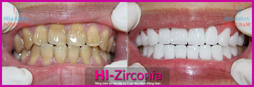 rang-su-211-4-ngoisao.vn-w500-h172 1 Nha khoa đông nam, Bọc răng sứ, Làm răng sứ, Răng sứ thẩm mỹ