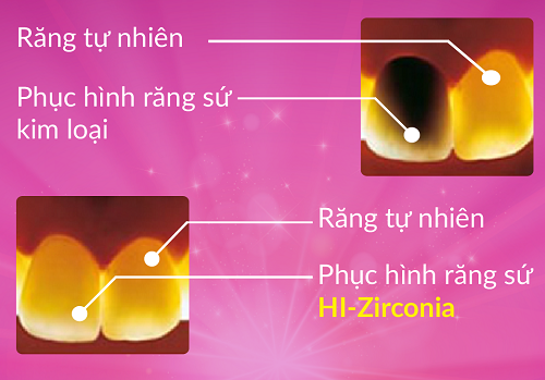 rang-su-211-5-ngoisao.vn-w500-h349 0 Nha khoa đông nam, Bọc răng sứ, Làm răng sứ, Răng sứ thẩm mỹ