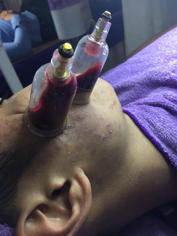 my-duyen-spa-2911-3-ngoisao.vn-w580-h774 2 Mỹ Duyên Spa, Chữa mụn bằng đông y, Chữa mụn