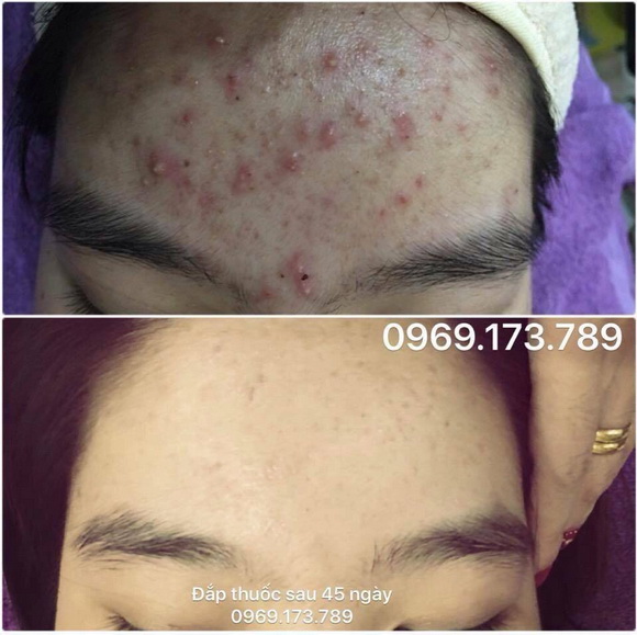 my-duyen-spa-2911-4-ngoisao.vn-w580-h579 1 Mỹ Duyên Spa, Chữa mụn bằng đông y, Chữa mụn