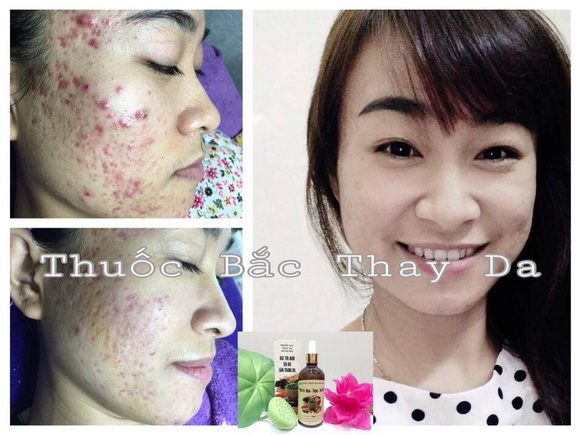 my-duyen-spa-2911-5-ngoisao.vn-w580-h435 0 Mỹ Duyên Spa, Chữa mụn bằng đông y, Chữa mụn