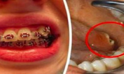 niềng răng, tai nạn niềng răng, tai nạn niềng răng đáng sợ trên thế giới 