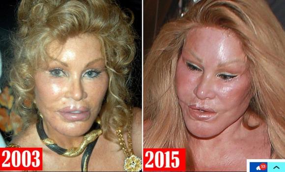 sao ngoại, thảm họa thẩm mỹ, Jocelyn Wildenstein,  thảm họa thẩm mỹ hành hưng bạn trai