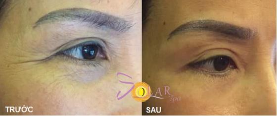 solar-spa-2112-1-ngoisao.vn-w560-h234 3 Xóa nhăn đuôi mắt, đánh tan bọng mỡ mắt, solar spa
