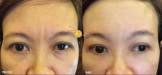 solar-spa-2112-2-ngoisao.vn-w560-h260 2 Xóa nhăn đuôi mắt, đánh tan bọng mỡ mắt, solar spa