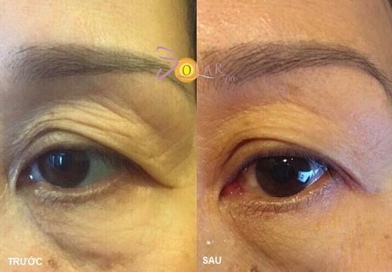 solar-spa-2112-3-ngoisao.vn-w560-h389 1 Xóa nhăn đuôi mắt, đánh tan bọng mỡ mắt, solar spa