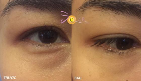 solar-spa-2112-4-ngoisao.vn-w560-h322 0 Xóa nhăn đuôi mắt, đánh tan bọng mỡ mắt, solar spa
