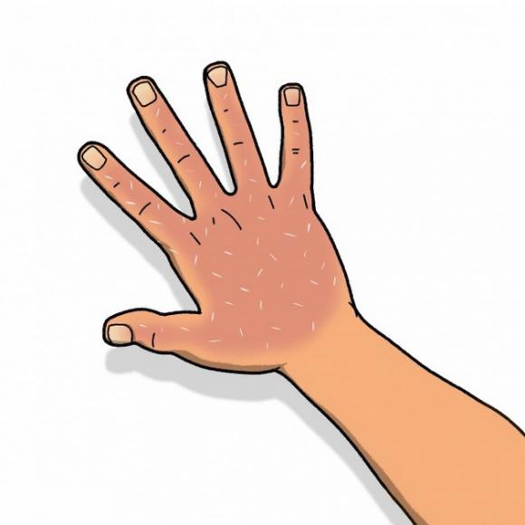 cước tay, cước tay mùa đông, cước chân tay, cước chân tay mùa đông, cước chân tay mùa lạnh