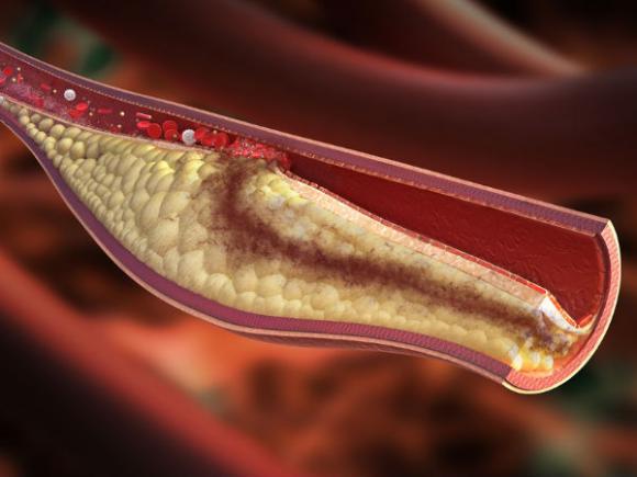 mỡ máu, huyết áp cao, cholesterol cao, công thức quét sạch mỡ máu, công thức giảm mỡ máu