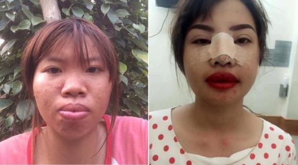 phẫu thuật thẩm mỹ, mẹ đơn thân, mẹ đơn thân phẫu thuật thẩm mỹ, đập mặt đi làm lại, cô gái đập mặt đi làm lại 