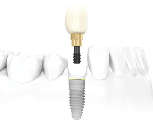 cay-ghep-nha-khoa-114-1-ngoisao.vn-w500-h398 3 Nha Khoa Đông Nam, cấy ghép Implant, Trồng răng
