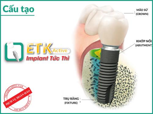 cay-ghep-nha-khoa-114-3-ngoisao.vn-w500-h373 1 Nha Khoa Đông Nam, cấy ghép Implant, Trồng răng