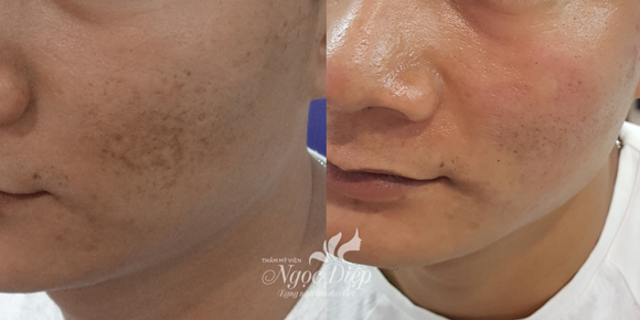 Trị sẹo, Trị sẹo rỗ, Phương pháp trị sẹo, Thẩm Mỹ Viện Ngọc Diệp, bác sĩ Ngọc Diệp