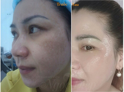 Trị nám, Thẩm mỹ viện Ngọc Diệp, Nám da